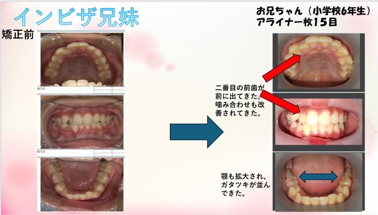 インビザライン・マウスピース矯正　兄妹15枚目