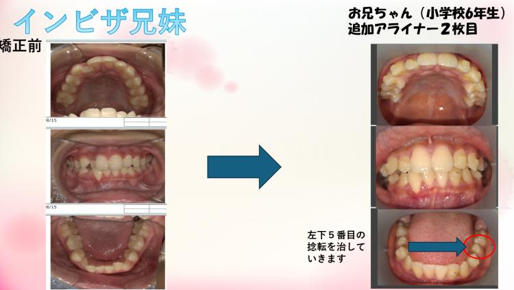 インビザライン・マウスピース矯正 兄　追加1枚目、妹　終了