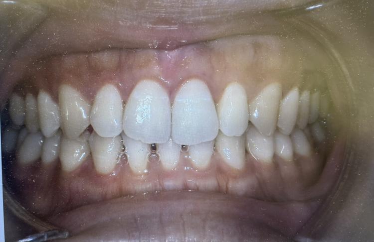 インビザライン・マウスピース矯正　保定