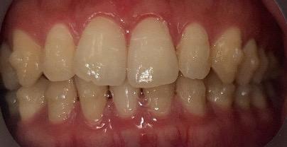 インビザライン・マウスピース矯正　10枚目