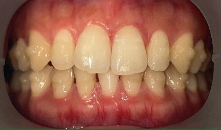 インビザライン・マウスピース矯正14枚目