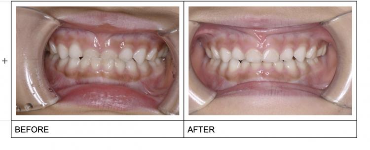 幼児矯正の考え方