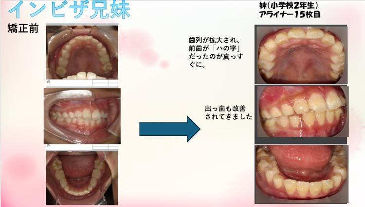 インビザライン・マウスピース矯正　兄妹15枚目