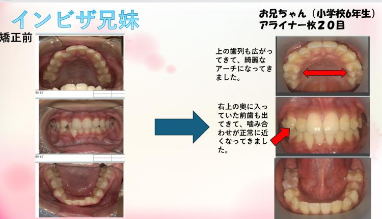 インビザライン・マウスピース矯正　兄妹　20枚目