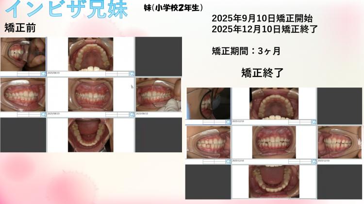インビザライン・マウスピース矯正 兄　追加1枚目、妹　終了