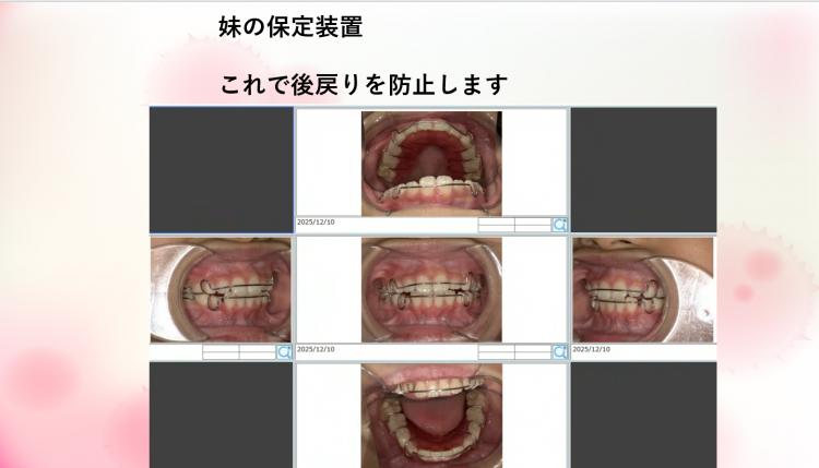 インビザライン・マウスピース矯正 兄　追加1枚目、妹　終了