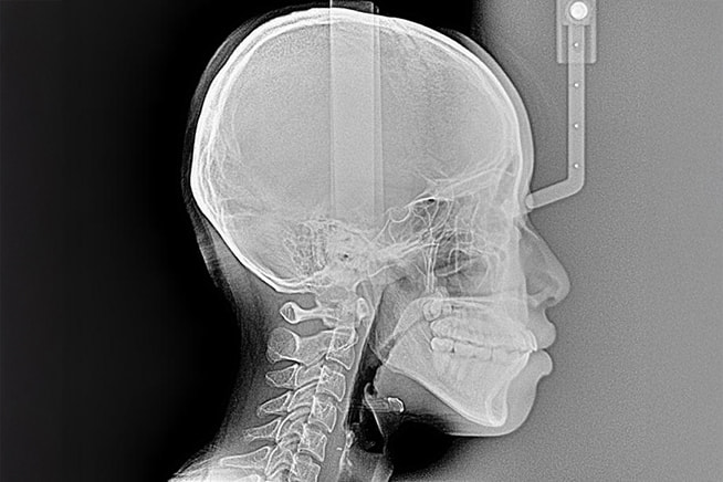 矯正専用レントゲン（セファロ）