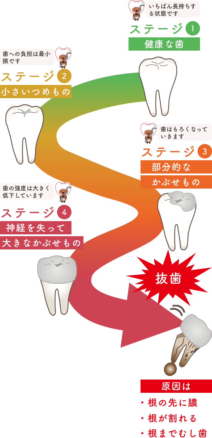 むし歯治療を重ねた歯に、実際に起きていること