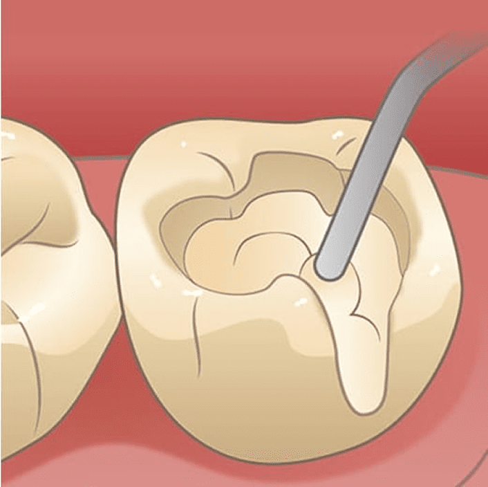 CR（樹脂・プラスチック）充填