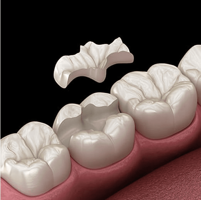 ンレー・クラウン（銀・金・セラミック）