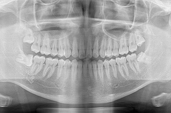 レントゲンによるチェック