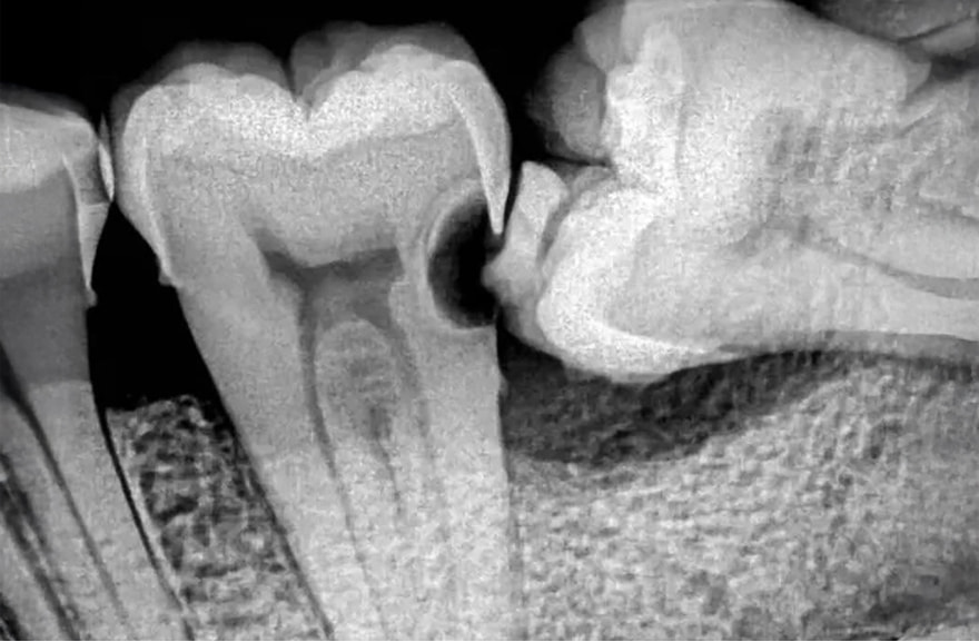 深刻なむし歯の原因になります